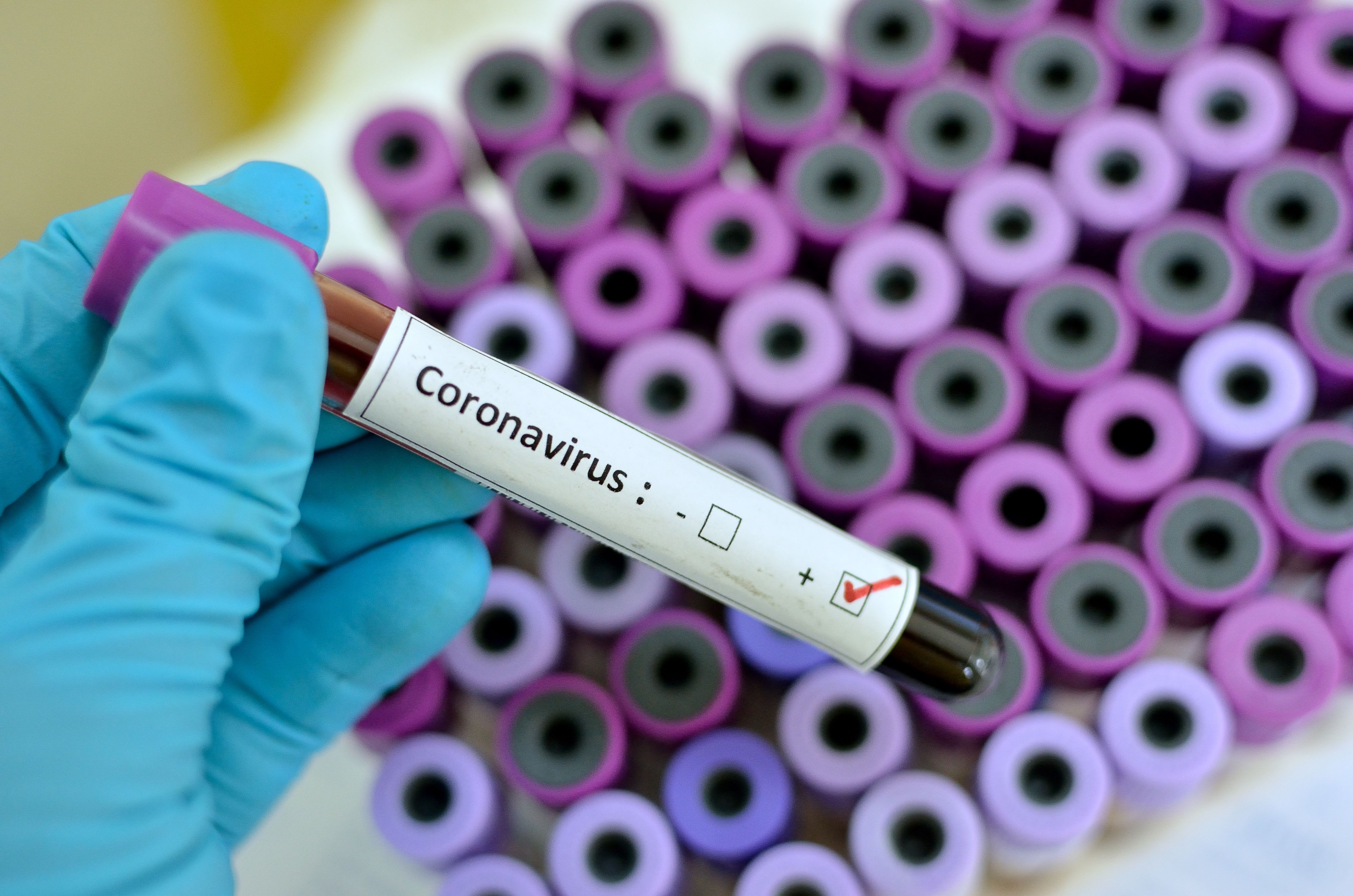 Proves de coronavirus. Foto: Arxiu